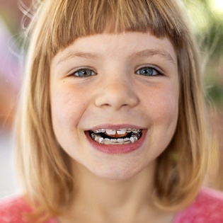 Can You Get Braces With Missing Teeth?