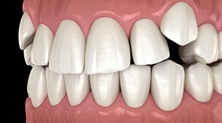 Illustration of impacted canine teeth