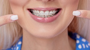 An up-close look at a young female’s mouth who has clear ceramic braces and who is pointing to her smile